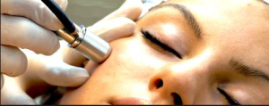 dermabrasion